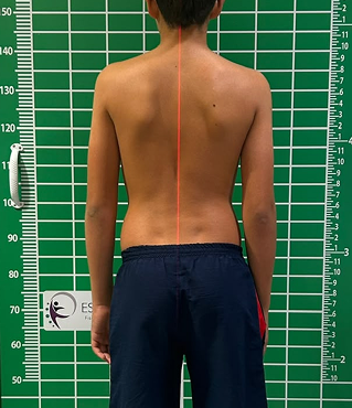 Paciente após tratamento com exercícios e colete S4D