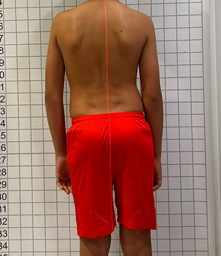 Paciente antes do tratamento com exercícios e colete S4D