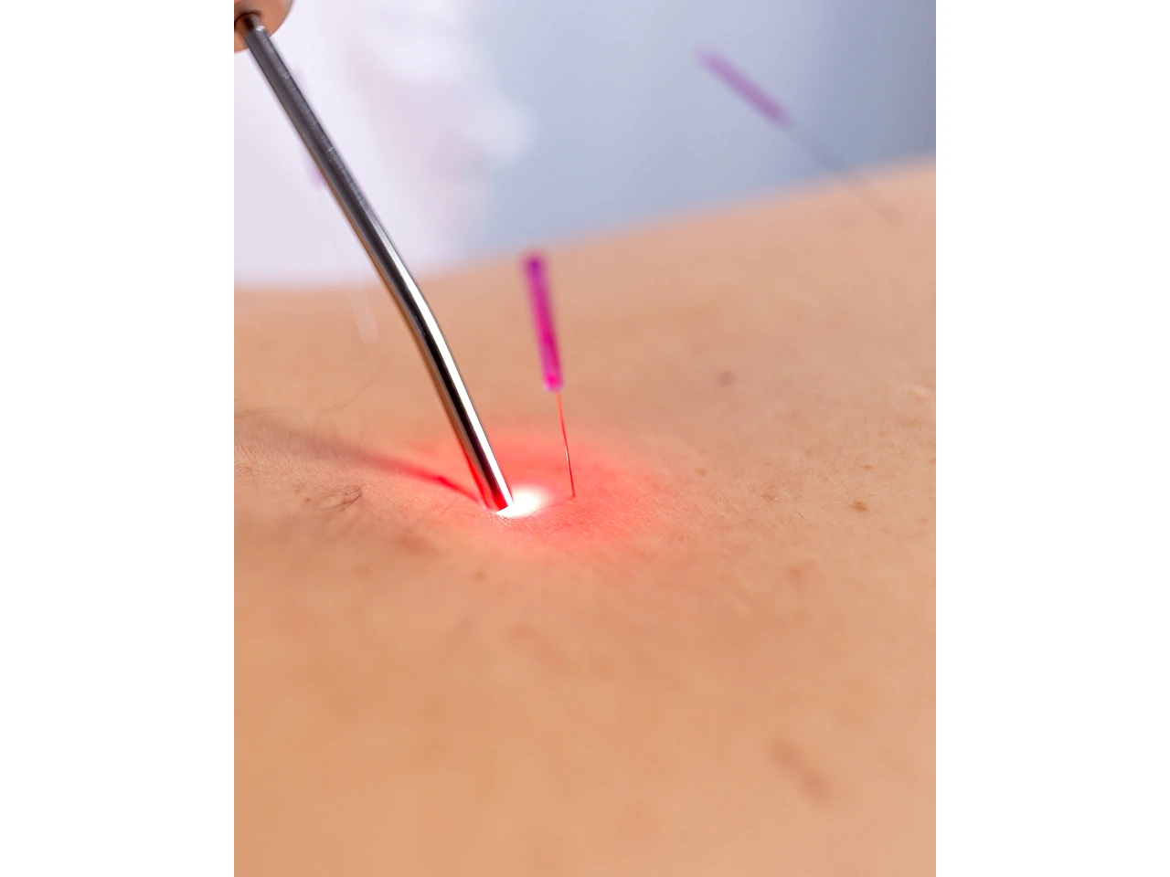 Acupuntura e Laser